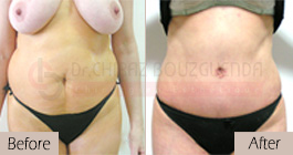 Tummy-tuck-before-after-abroad-tunisia-patient3