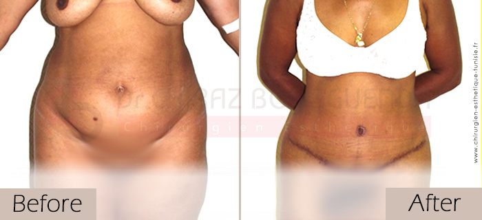 Tummy-tuck-before-after-abroad-tunisia-patient4