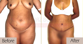 Tummy-tuck-before-after-abroad-tunisia-patient4