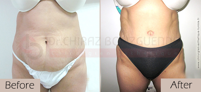 Tummy-tuck-before-after-abroad-tunisia-patient5