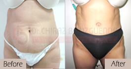 Tummy-tuck-before-after-abroad-tunisia-patient5