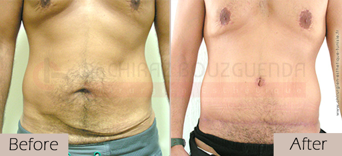 Tummy-tuck-before-after-abroad-tunisia-patient6