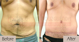 Tummy-tuck-before-after-abroad-tunisia-patient6