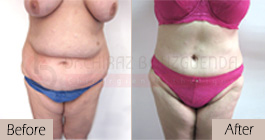 Tummy-tuck-before-after-abroad-tunisia-patient7