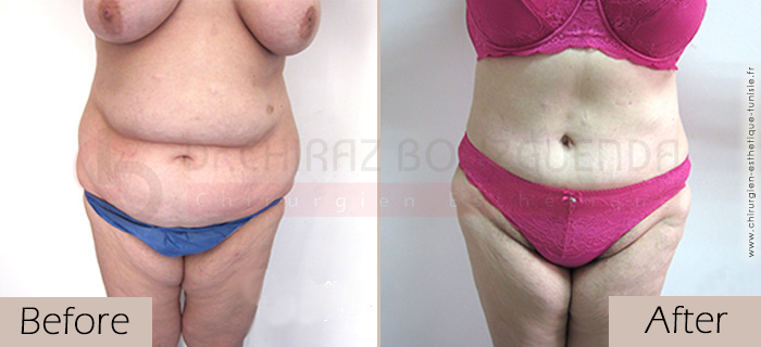 Tummy-tuck-before-after-abroad-tunisia-patient7