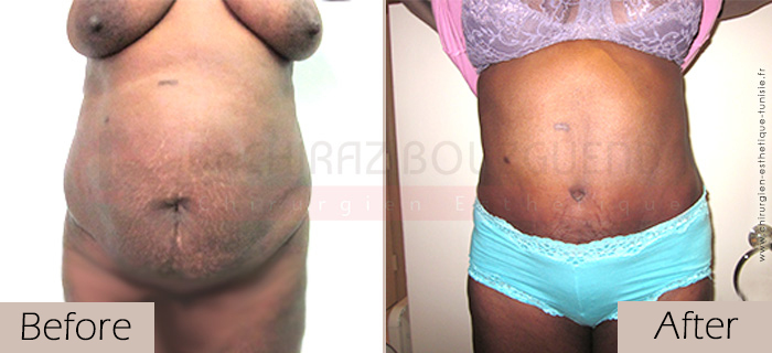 Tummy-tuck-before-after-abroad-tunisia-patient8