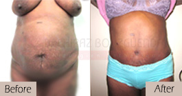 Tummy-tuck-before-after-abroad-tunisia-patient8