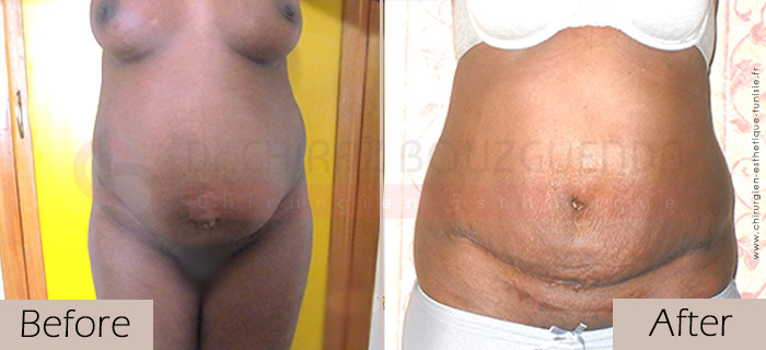 Tummy-tuck-before-after-abroad-tunisia-patient9