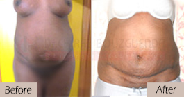 Tummy-tuck-before-after-abroad-tunisia-patient9